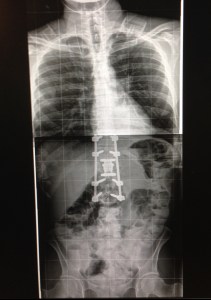 Niall's new spine